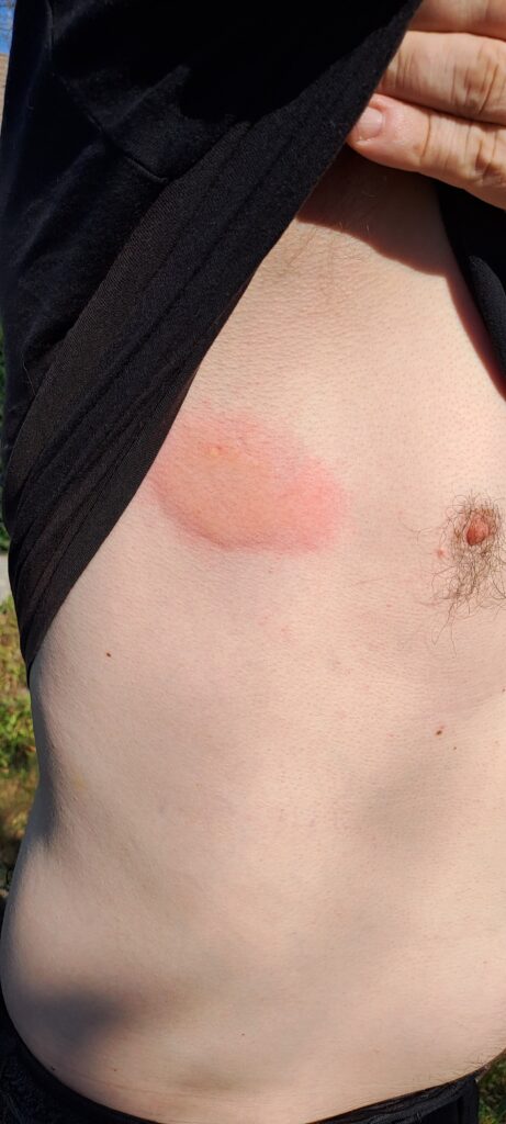 Piqure de frelon asiatique